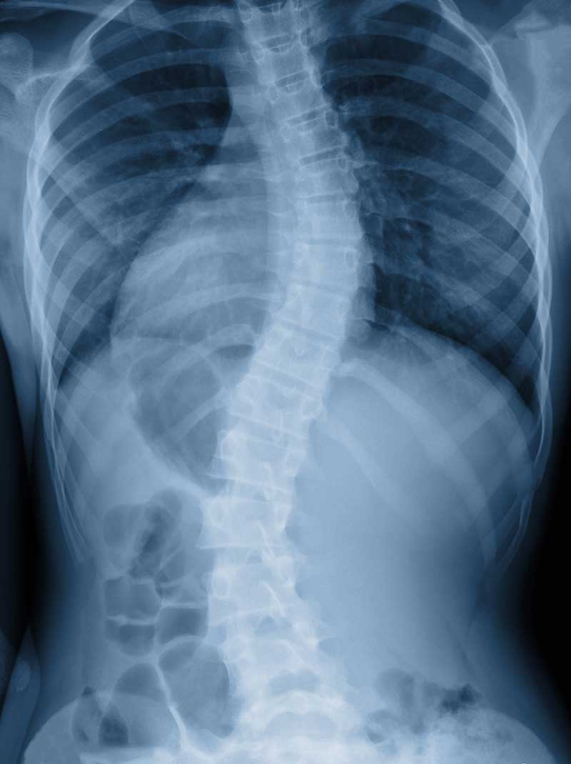 Scoliosis Gardena, CA